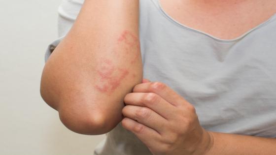 دراسة أمريكية تكشف دور العنب يساعد في الوقاية من سرطان الجلد