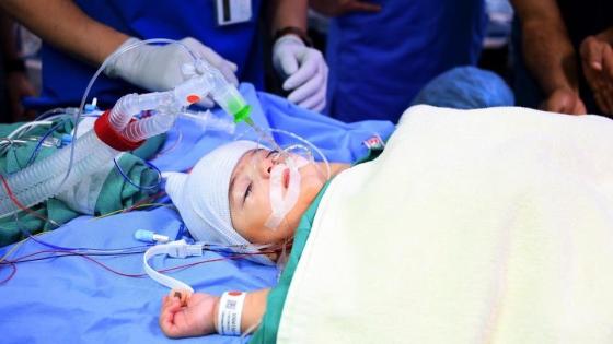 نجاح عملية فصل التوأم السيامي الليبي داخل مستشفى الملك عبد الله للأطفال